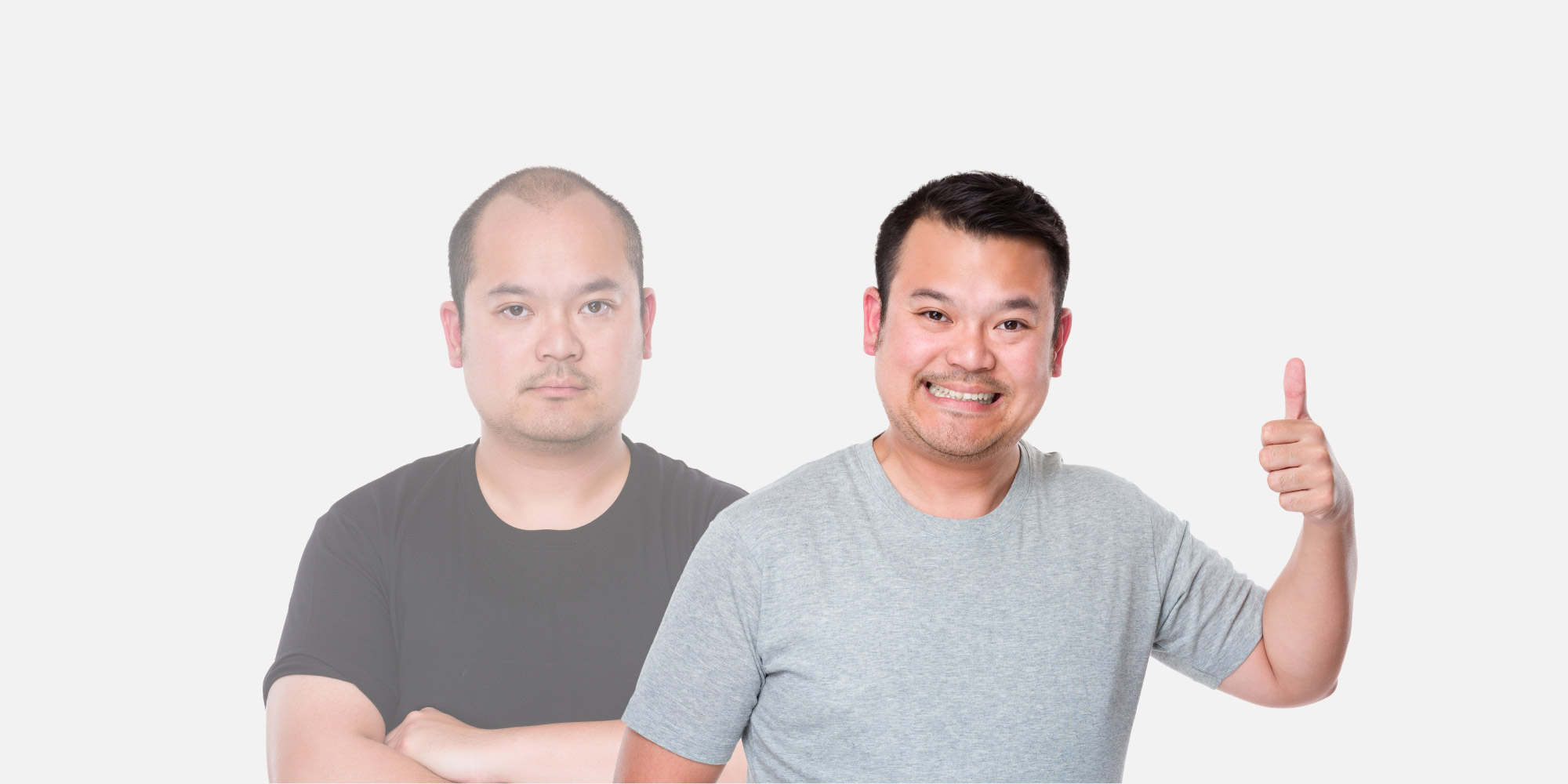 male pattern baldness