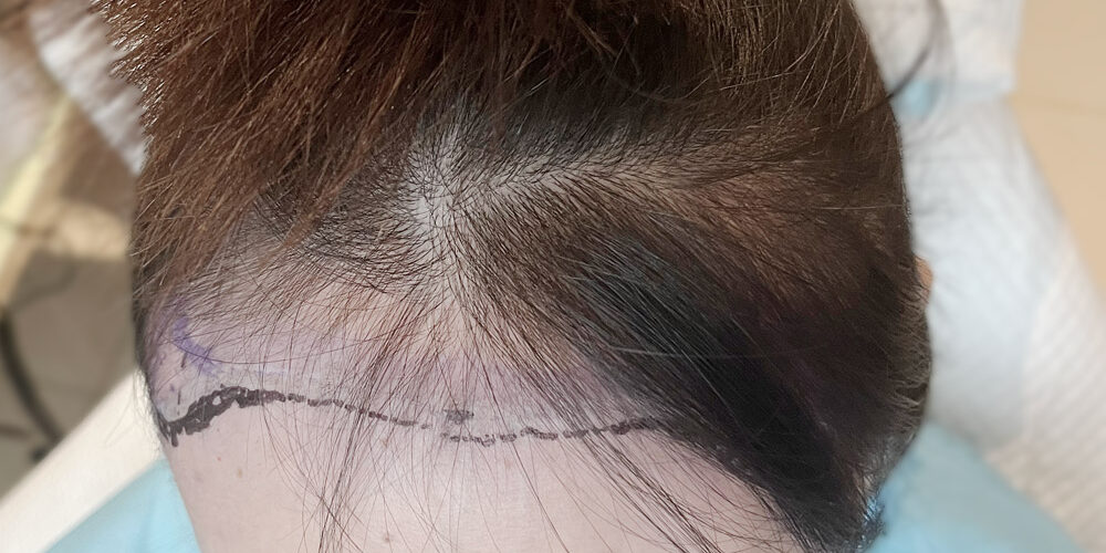 How to Stop Receding Hairline