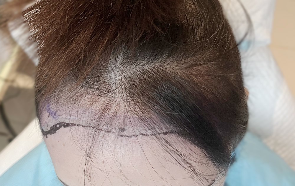 How to Stop Receding Hairline