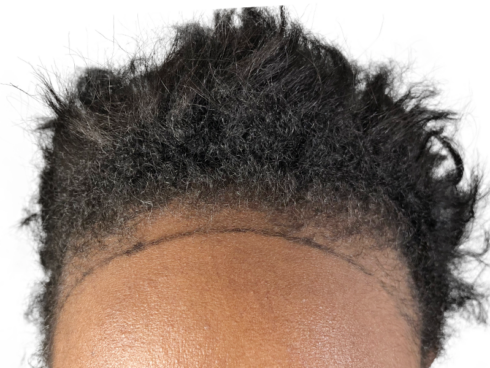 Hairline Transplant for a Fuller and Natural Look