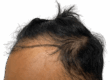 Hairline Transplant for a Fuller and Natural Look