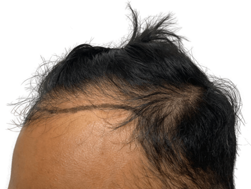 Hairline Transplant for a Fuller and Natural Look