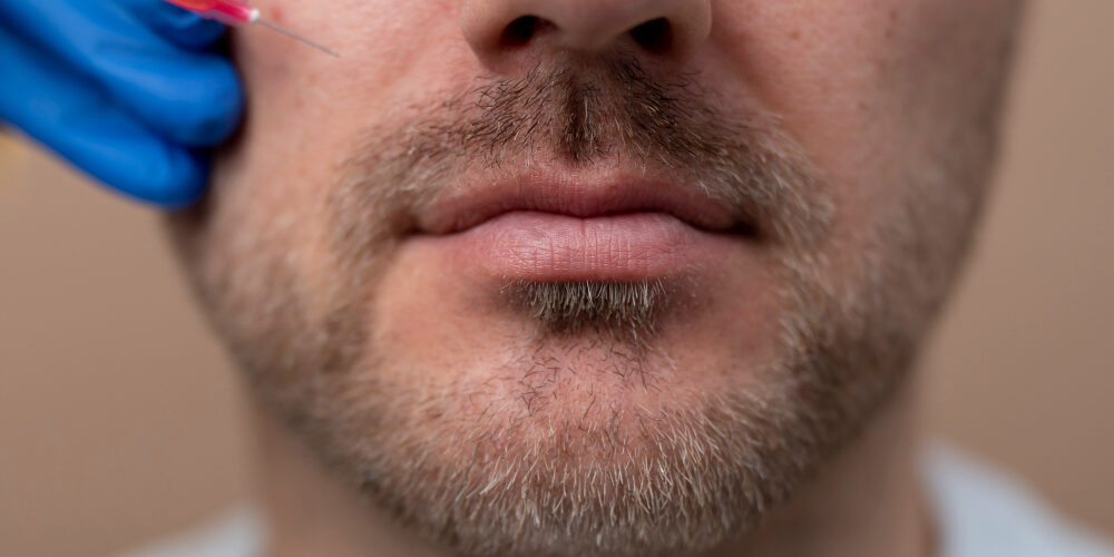 2149341465 beard transplant