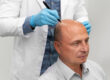 hair transplant
