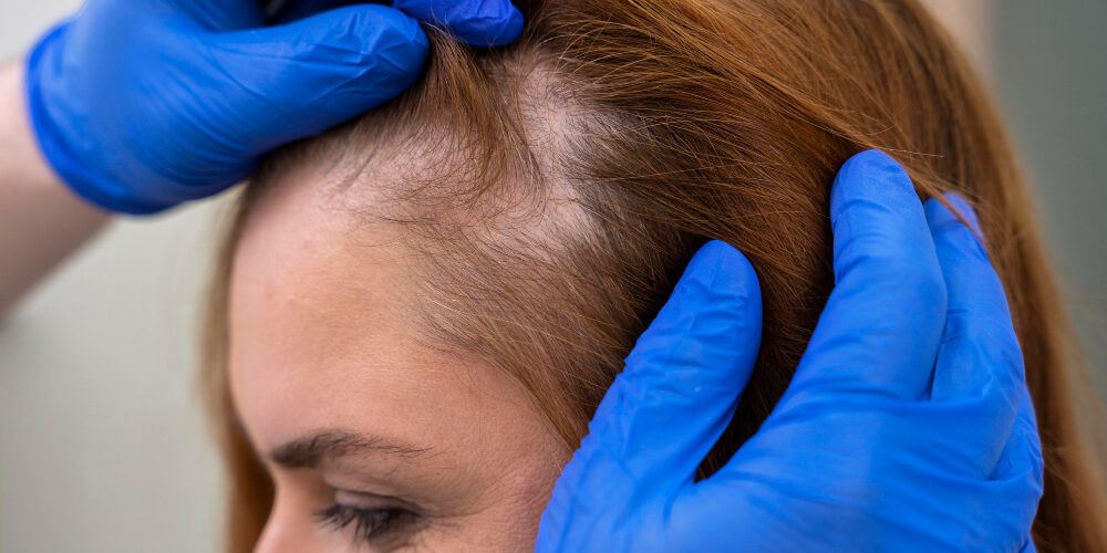 How to Cure Hair Loss