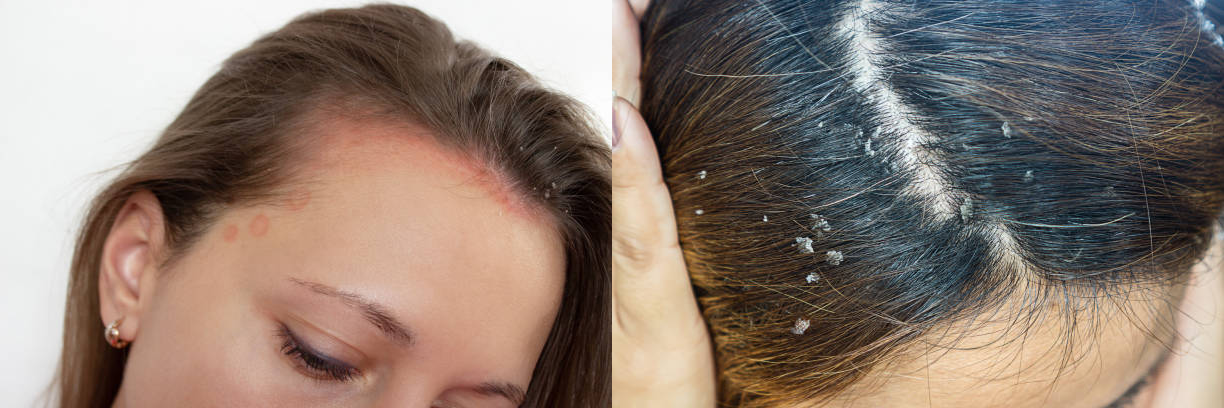 Scalp Psoriasis vs. Dandruff