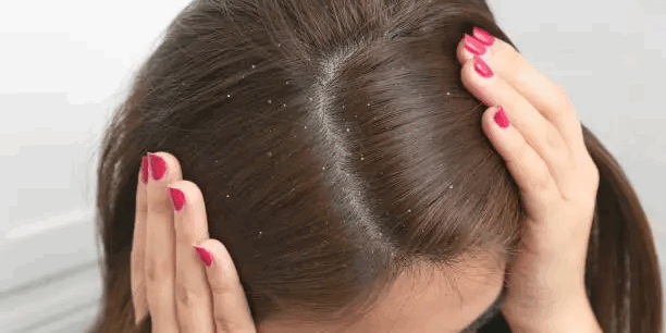 does dandruff cause hair loss