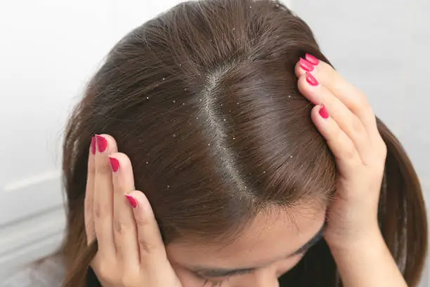 does dandruff cause hair loss