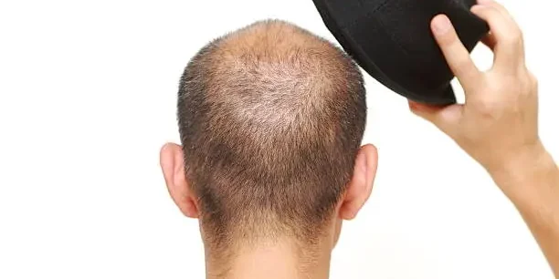 Does Wearing Cap Can Cause Baldness Does Wearing Cap Can Cause Baldness