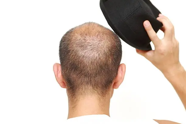Does Wearing Cap Can Cause Baldness