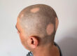 alopecia causes in males