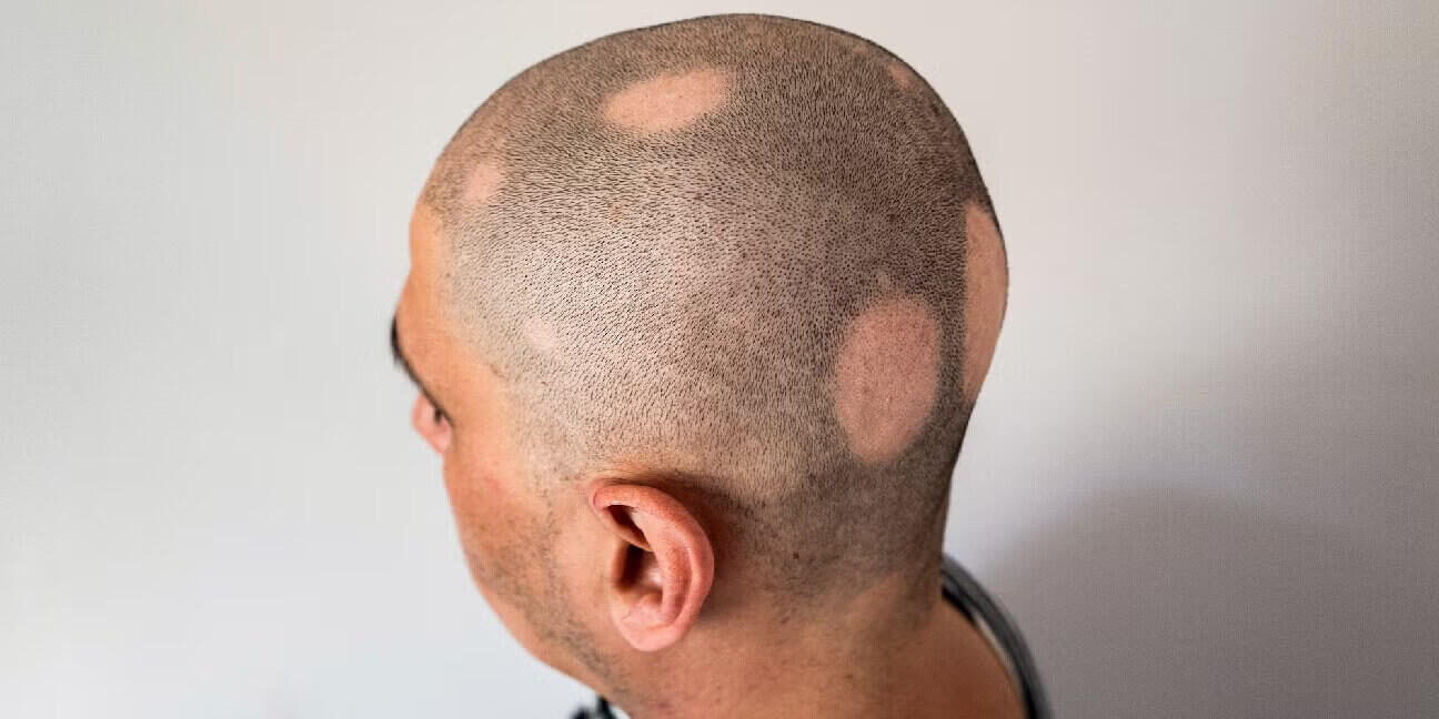 alopecia causes in males alopecia causes in males