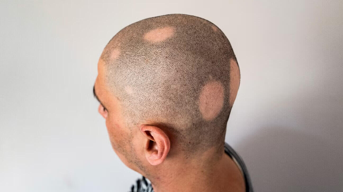 alopecia causes in males alopecia causes in males