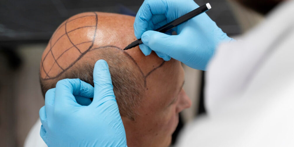 best hair transplant clinics in Manila best hair transplant clinics in manila