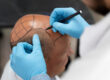 best hair transplant clinics in manila