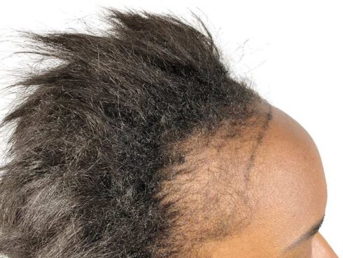 female hair transplants before