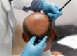 comparing fue and fut hair transplant