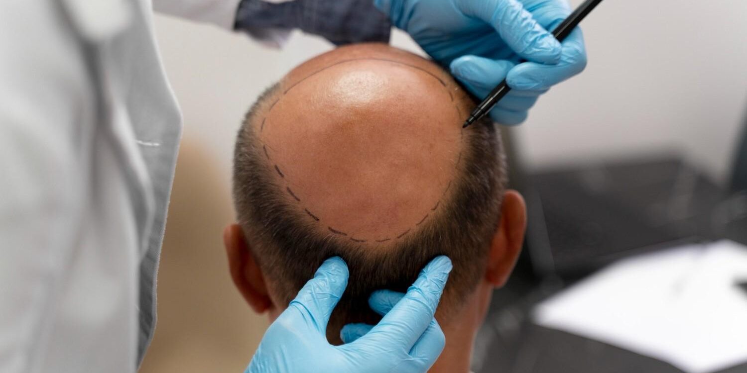 comparing fue and fut hair transplant