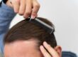 recovery time after hair transplant