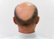 early stage male pattern baldness