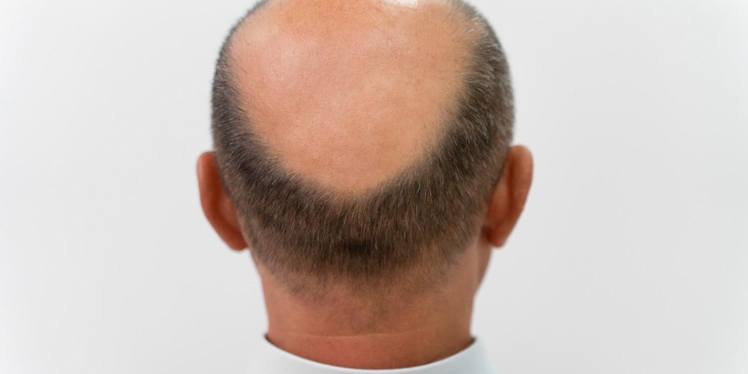 early-stage-male-pattern-baldness early stage male pattern baldness