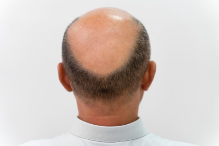 early stage male pattern baldness