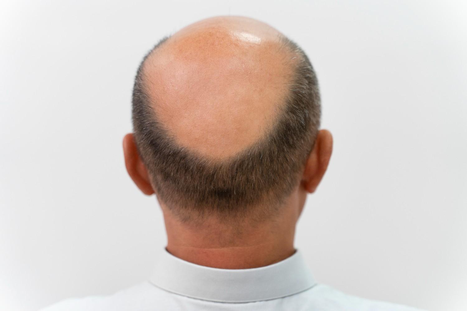 early stage male pattern baldness
