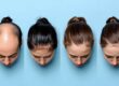 types of hair loss