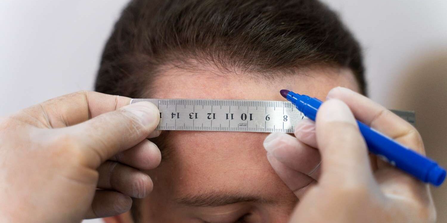 hair transplant price hair transplant price